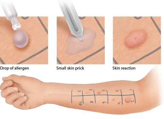 When to do blood allergy tests?