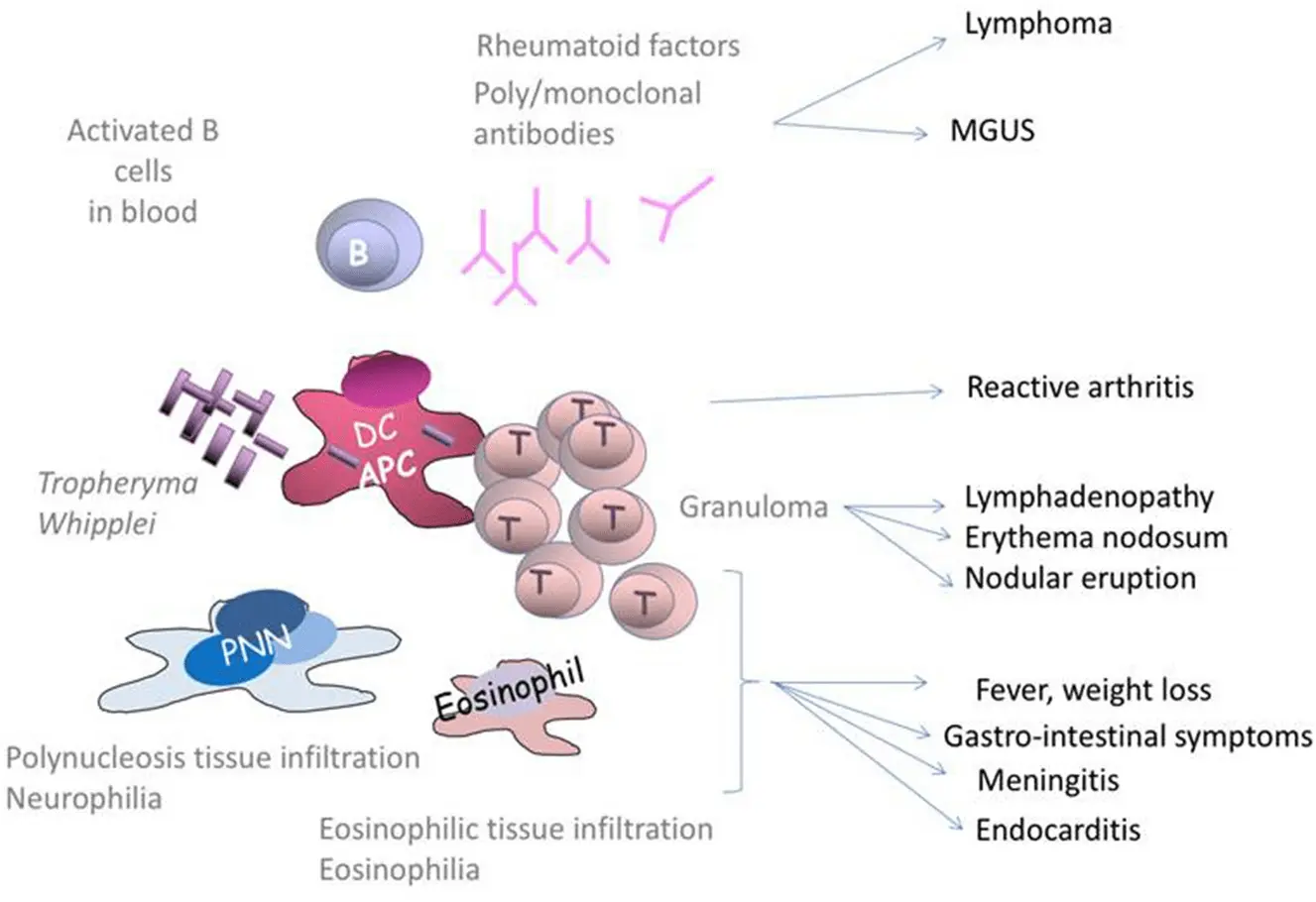 Whipple&#8217;s disease &#8211; causes, symptoms, diagnosis, treatment