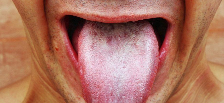 Бял налеп по езика – кога се появява? Как да избегна бели отлагания по езика си?