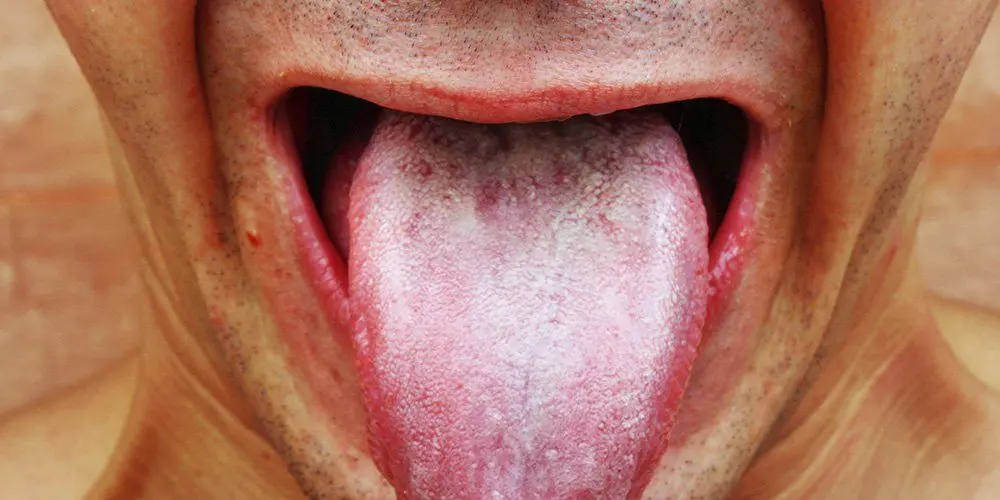 White coating on the tongue &#8211; when does it appear? How do I avoid white deposits on my tongue?