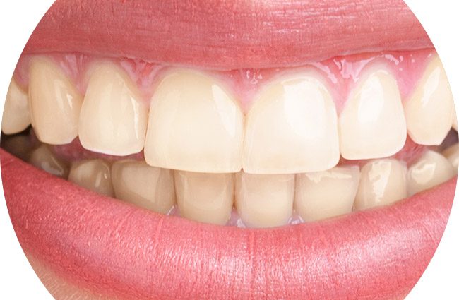 Whitening of hypersensitive teeth? Yes, it is possible