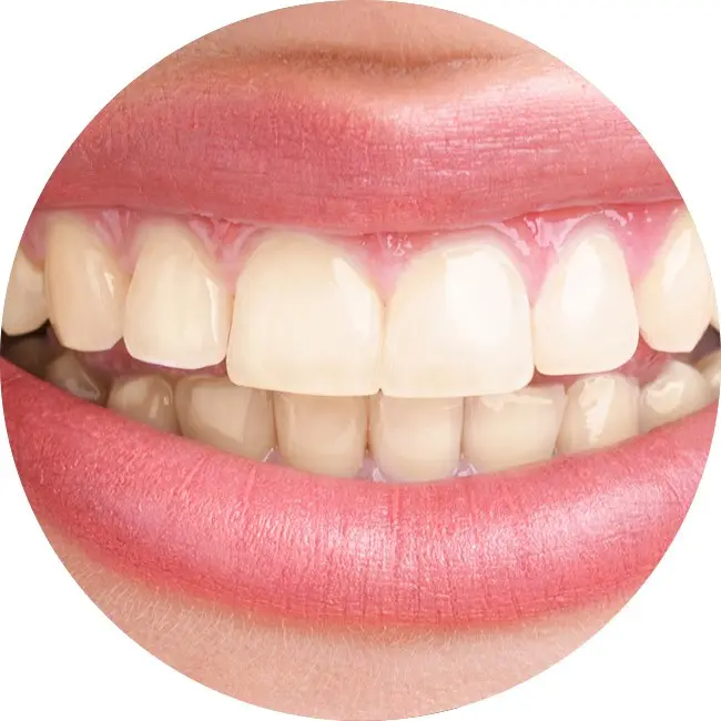 Whitening of hypersensitive teeth? Yes, it is possible