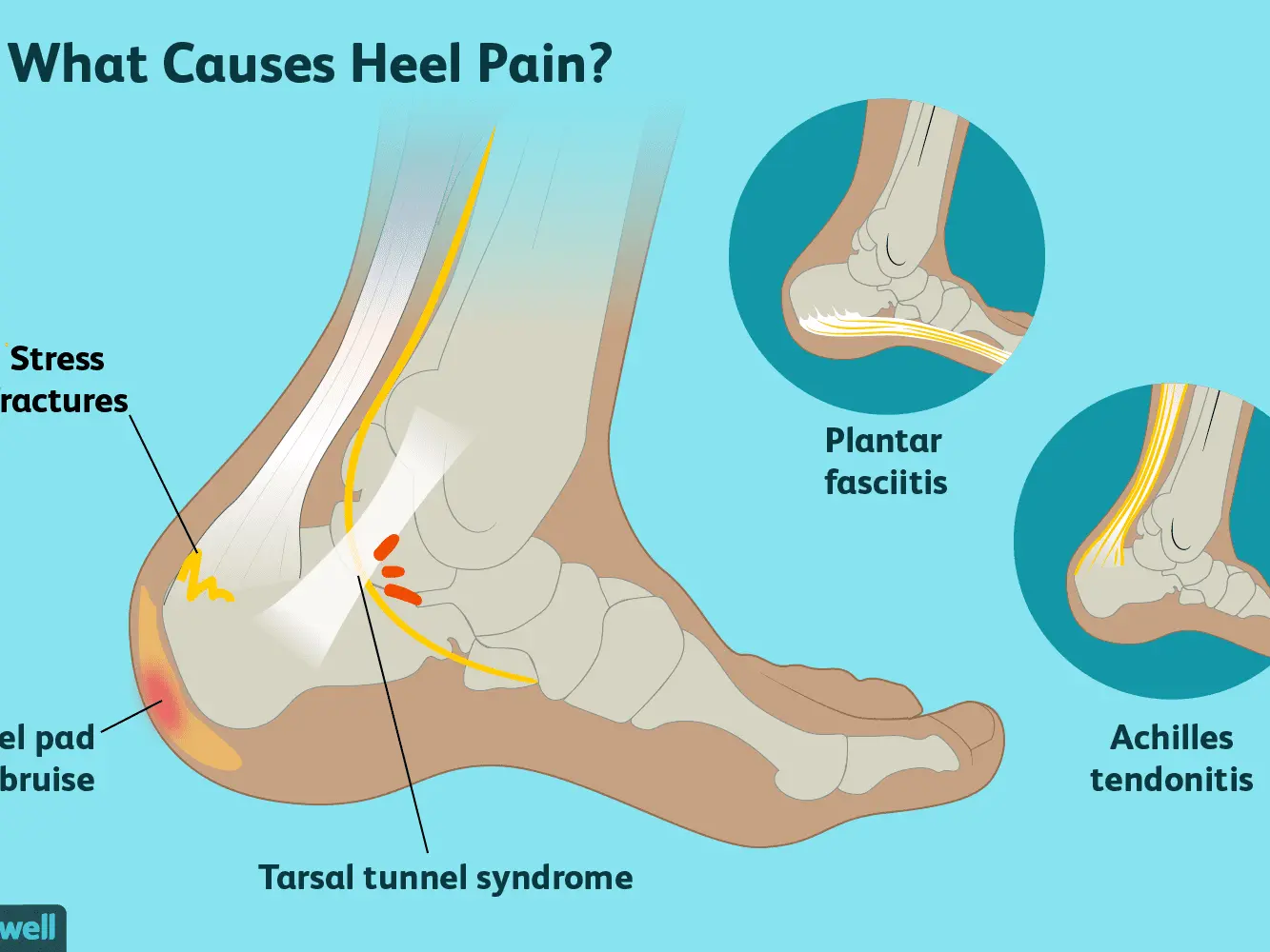 Why do heels hurt?