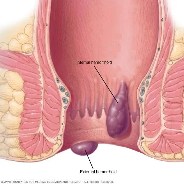 Why do hemorrhoids form?