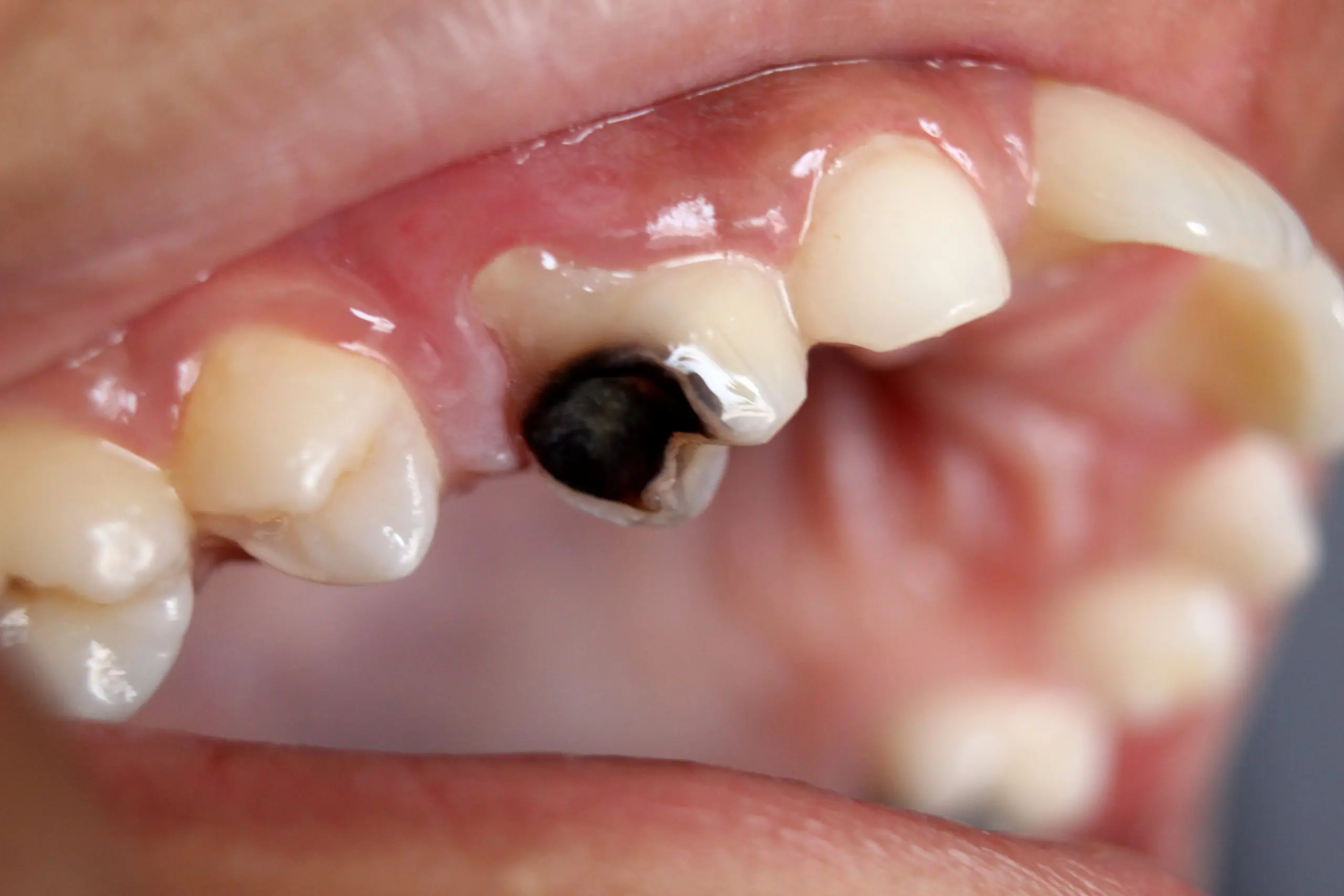 Why do teeth deteriorate?