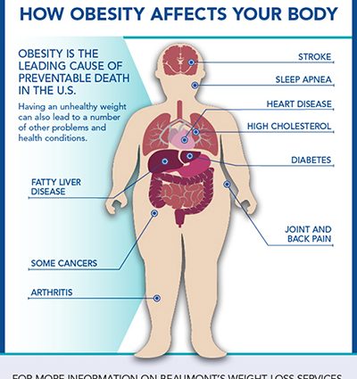 Why do you need to lose weight? These are the diseases that come from obesity