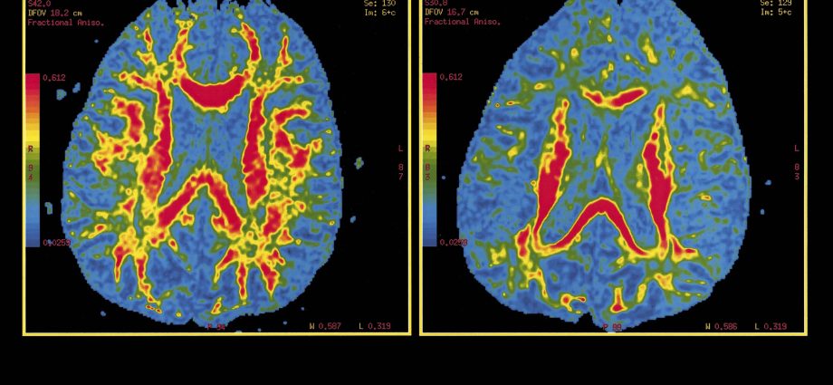 Will artificial intelligence recognize the onset of Alzheimer&#8217;s before symptoms appear?