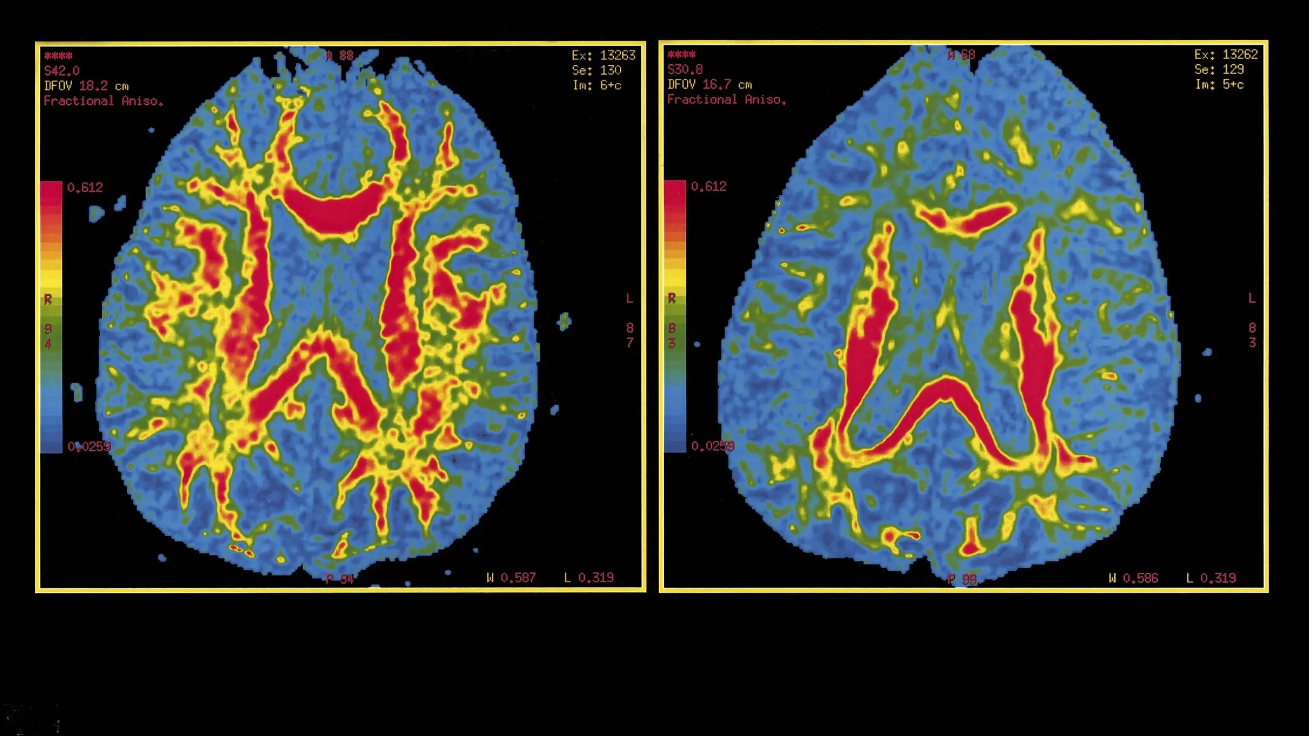 Will artificial intelligence recognize the onset of Alzheimer&#8217;s before symptoms appear?