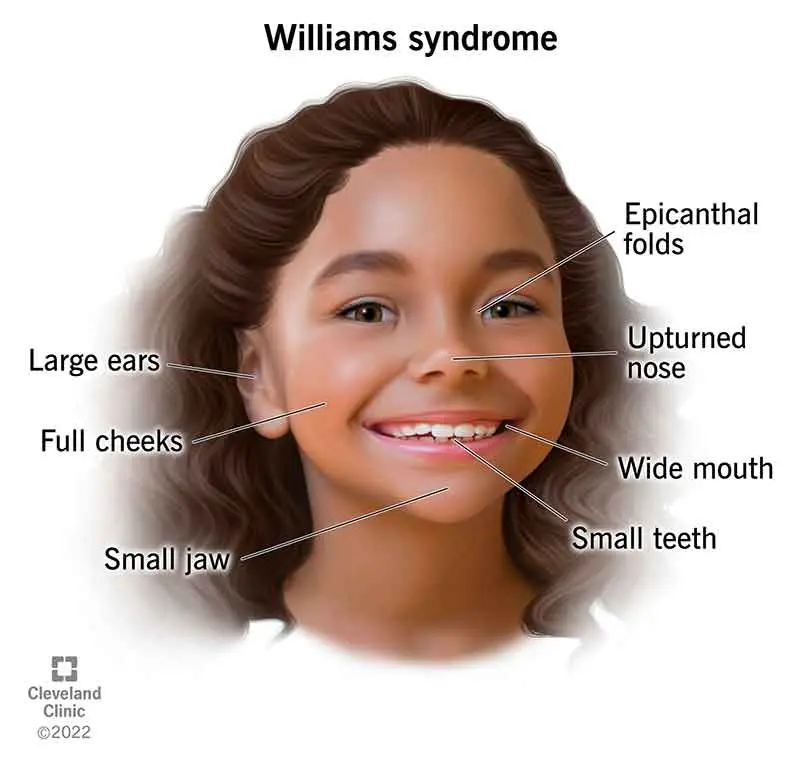 Williams syndrome &#8211; causes, symptoms, treatment