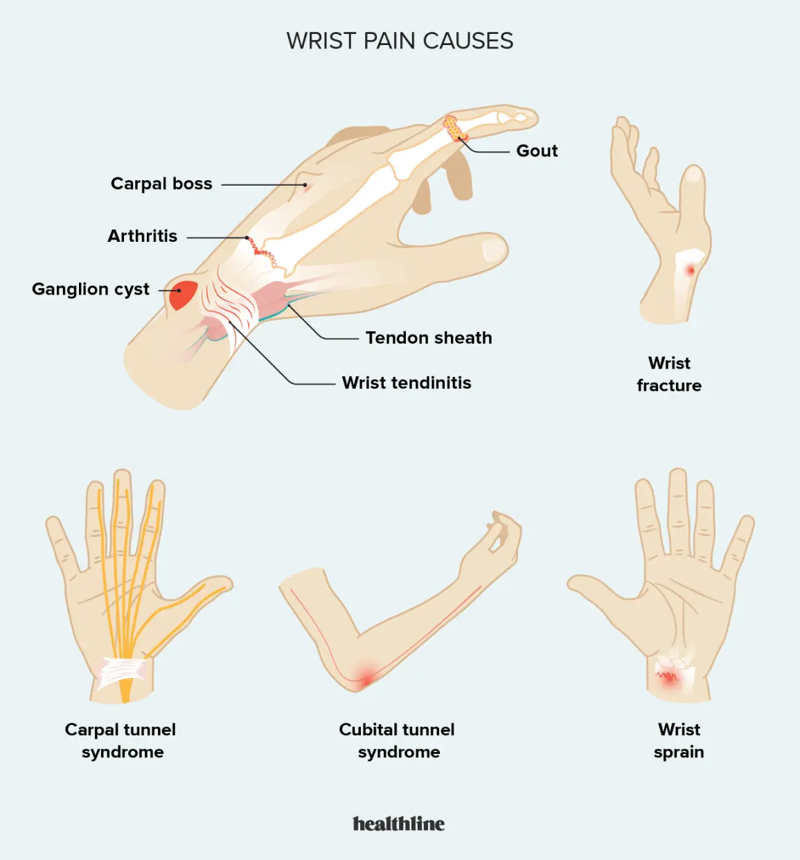 Wrist pain &#8211; what can it result from? Exercise and caring for the wrist