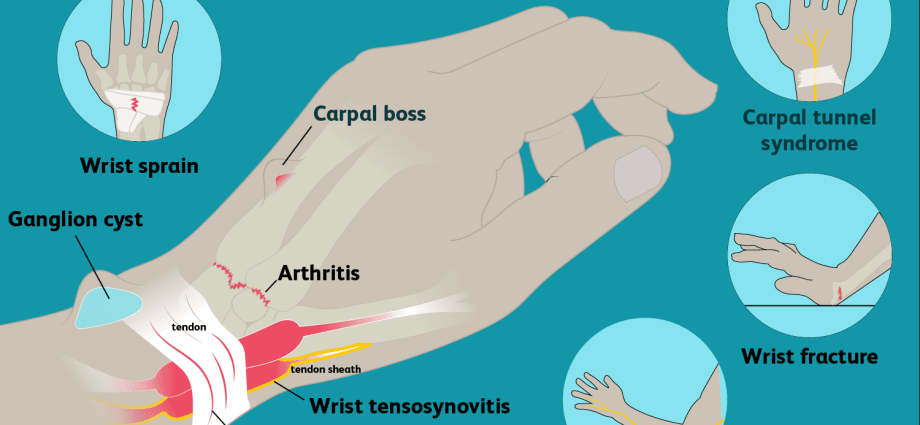 Wrist &#8211; why does it hurt? Structure, diseases and injuries of the wrist