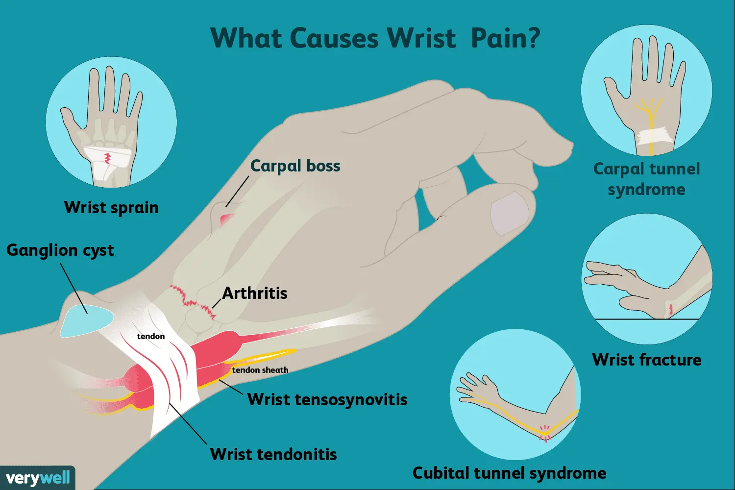 Wrist &#8211; why does it hurt? Structure, diseases and injuries of the wrist