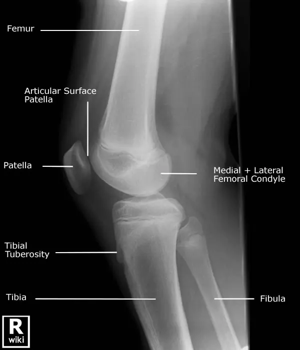 X-ray of the knee &#8211; what is it? Indications, preparation, appearance, price [EXPLAINED]