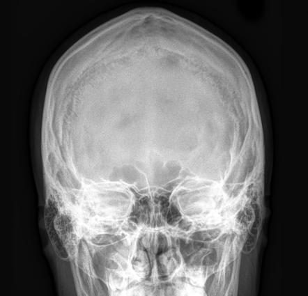 X-ray of the skull. What are the indications for its implementation?