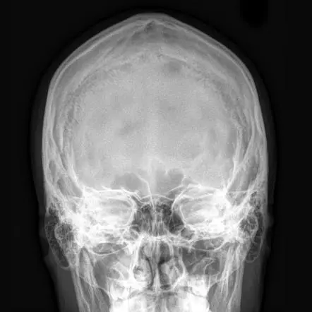 X-ray of the skull. What are the indications for its implementation?