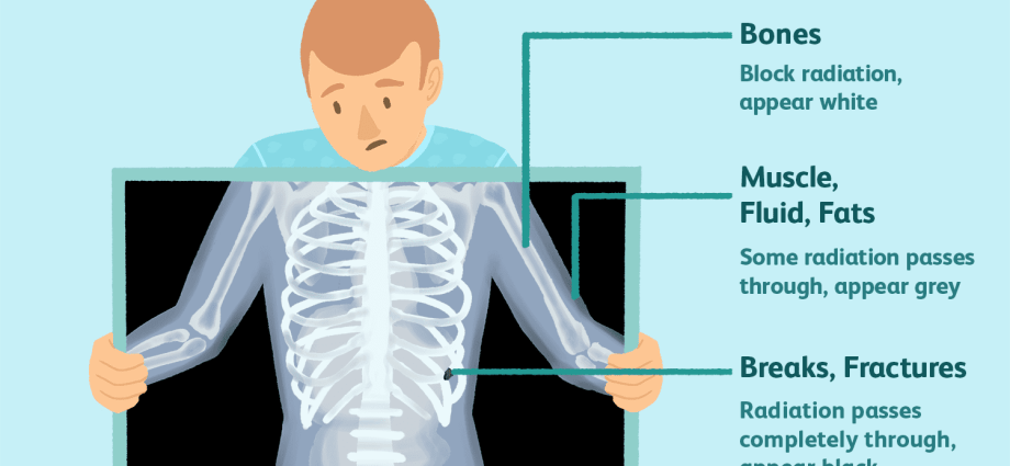 X-ray &#8211; what is it? Preparation, course and results of X-ray examination