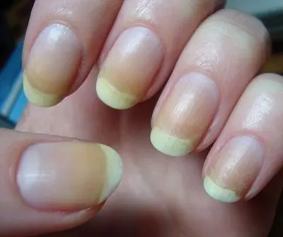 Yellow nails &#8211; causes and symptoms. How to get rid of yellow nails?