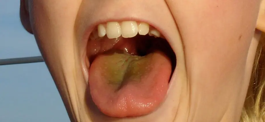 Yellow tongue &#8211; what can it show? When is it cause for concern?