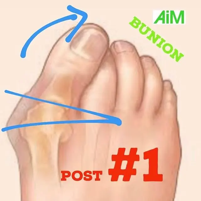 Yes, you &#8220;work&#8221; on bunions. What habits and conditions increase their likelihood?