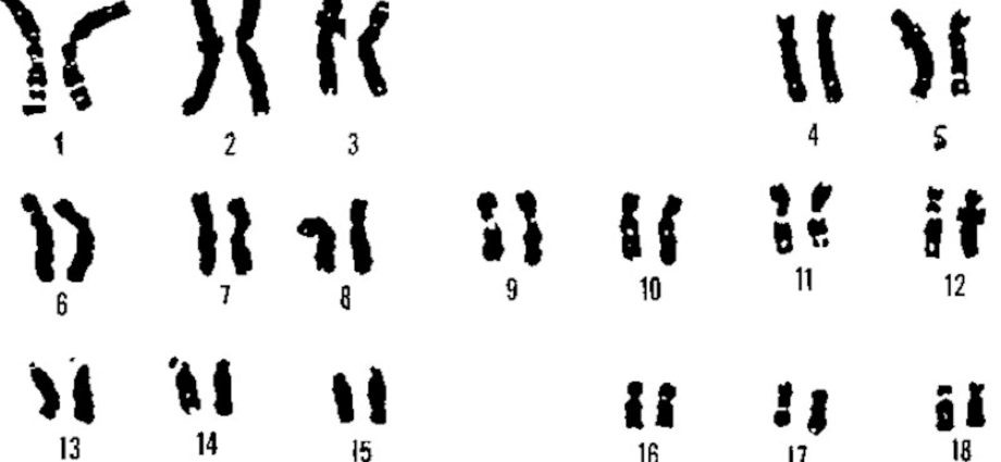 You can turn off the chromosome responsible for Down&#8217;s syndrome