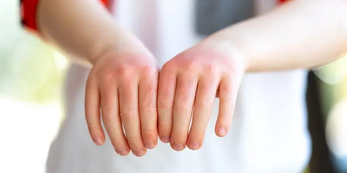 Your hands look like this? You may be seriously ill. Don&#8217;t take it lightly