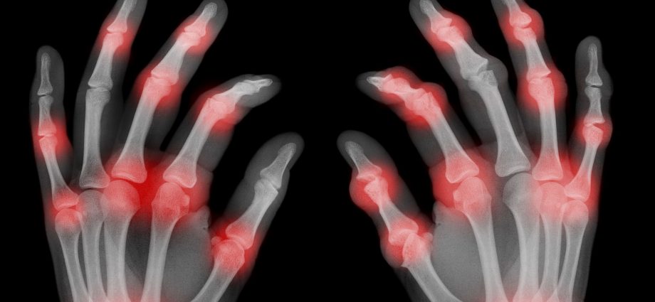 Your joints hurt so bad that you can&#8217;t screw in the light bulb? It could be a serious illness