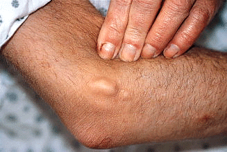 Your skin itches and you have bruises? Watch out, there may be kidney problems