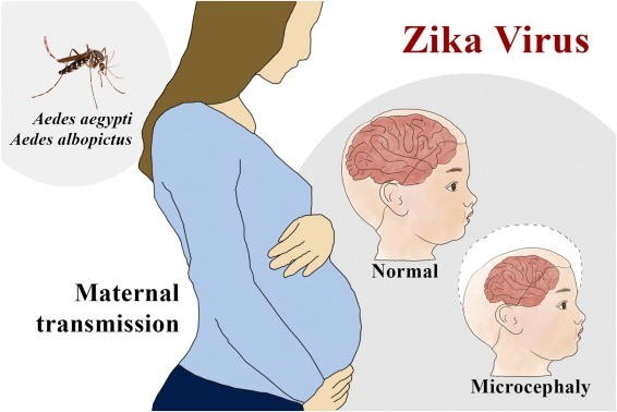 Zika virus and microcephaly (microcephaly) &#8211; symptoms, treatment