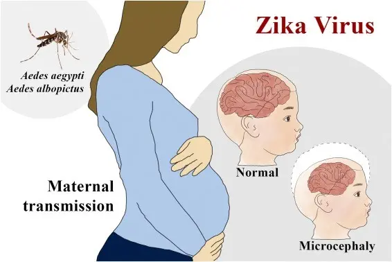 Zika virus and microcephaly (microcephaly) &#8211; symptoms, treatment