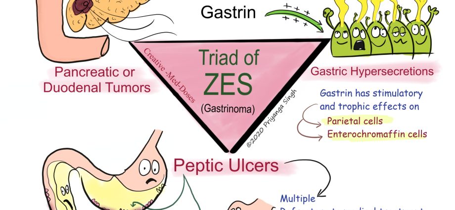 Zollinger-Ellison syndrome. The first symptoms of resistant ulcers