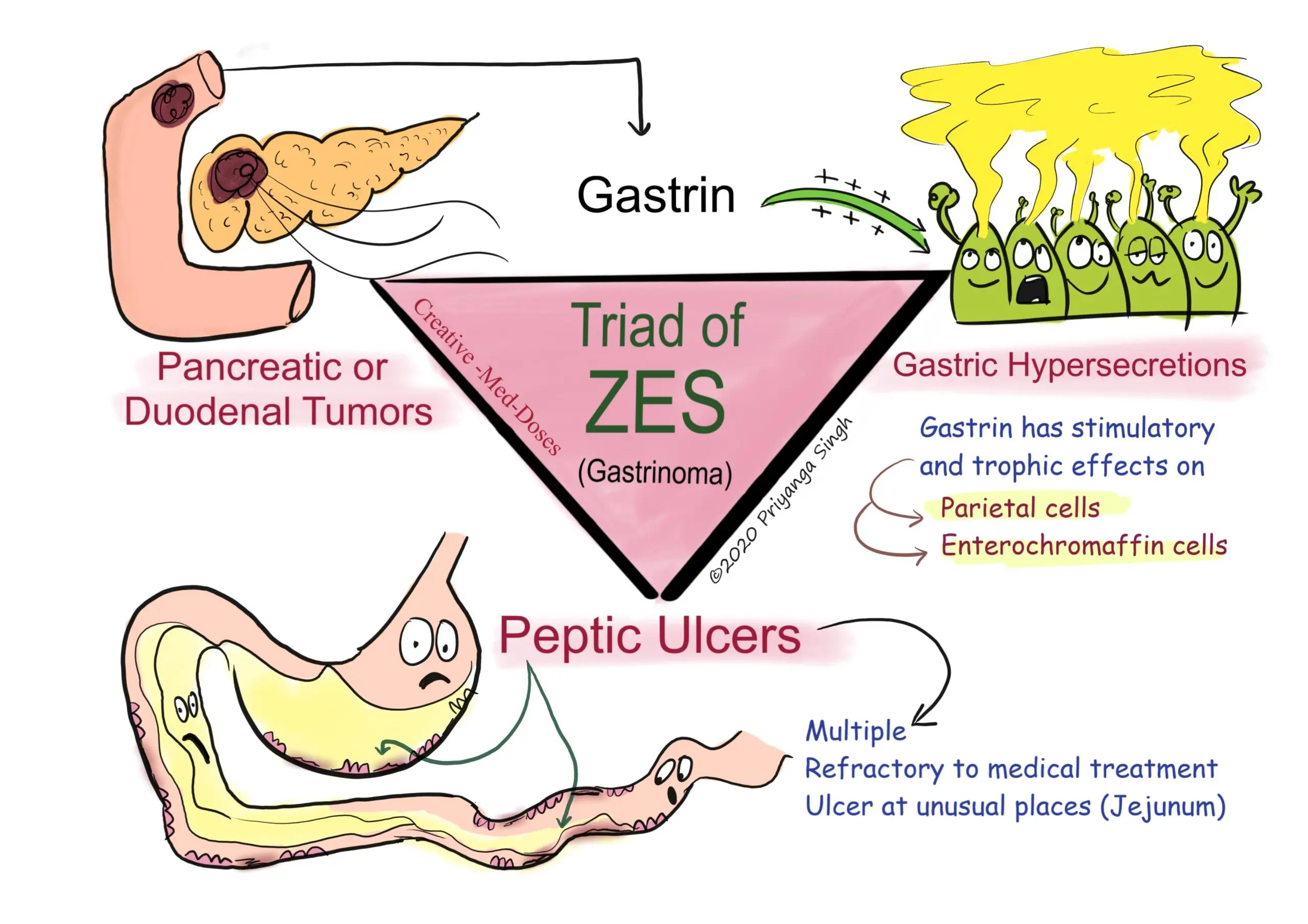 Zollinger-Ellison syndrome. The first symptoms of resistant ulcers