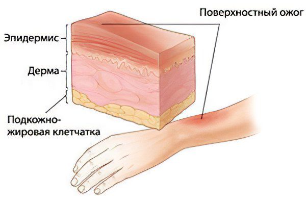 1st, 2nd, 3rd and 4th degree burns, signs and symptoms