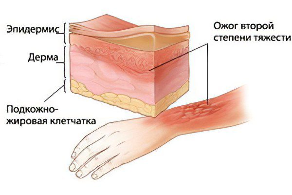 1st, 2nd, 3rd and 4th degree burns, signs and symptoms