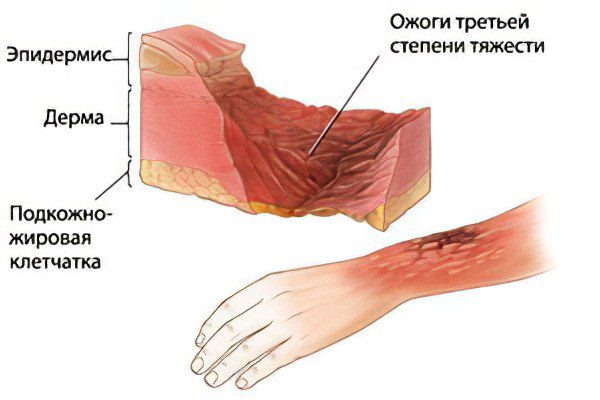 1st, 2nd, 3rd and 4th degree burns, signs and symptoms