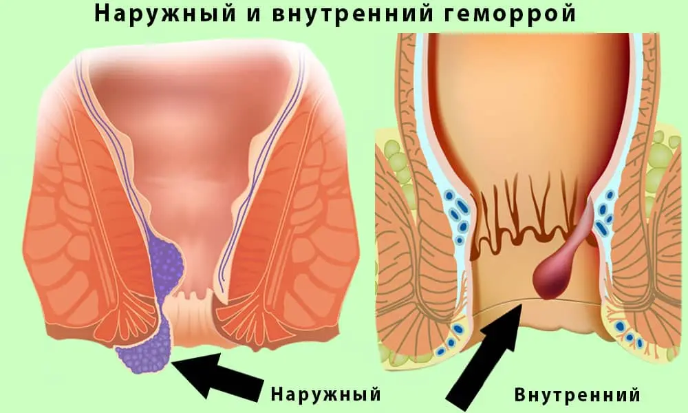 5 warning signs of hemorrhoids