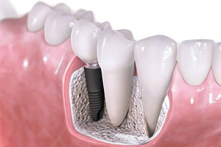 7 modern methods of dental treatment without pain