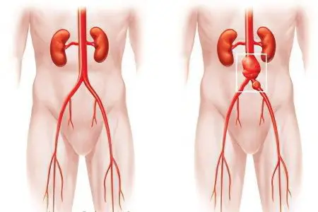 Abdominal aortic aneurysm