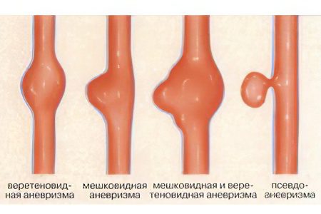 Abdominal aortic aneurysm