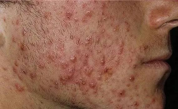 Acne: types and treatment Acne: types and treatment