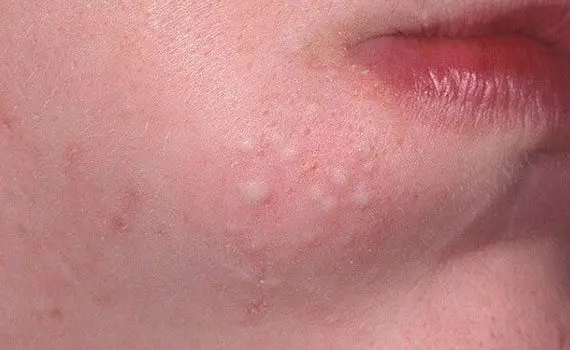 Acne: types and treatment Acne: types and treatment