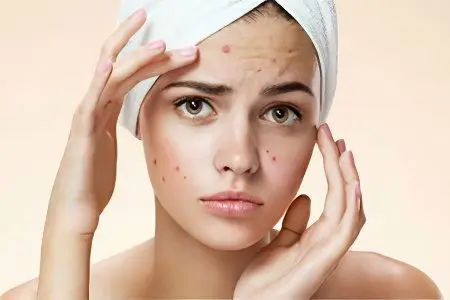 Acne: types and treatment