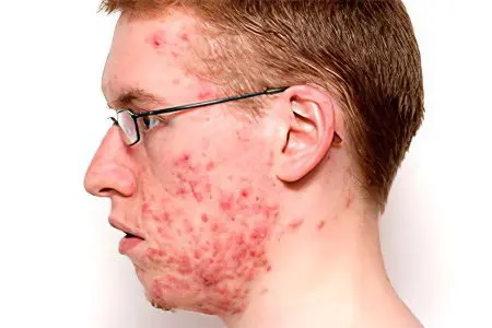 Acne: types and treatment