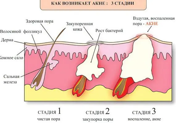 Acne: types and treatment Acne: types and treatment