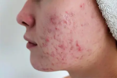 Acne: types and treatment