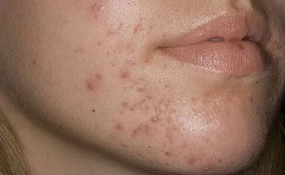 Acne: types and treatment Acne: types and treatment