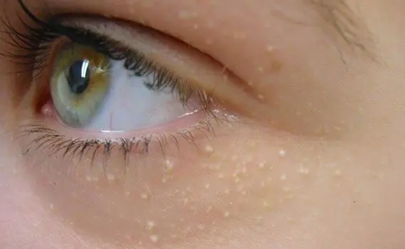 Acne: types and treatment Acne: types and treatment