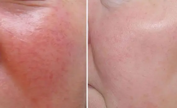 Acne: types and treatment Acne: types and treatment