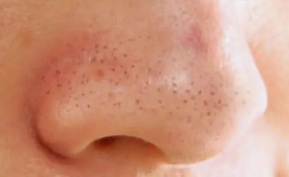 Acne: types and treatment Acne: types and treatment