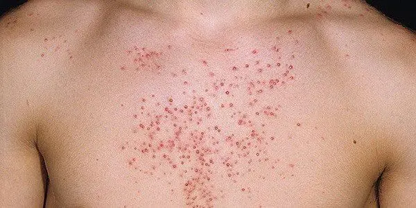 Acne: types and treatment Acne: types and treatment