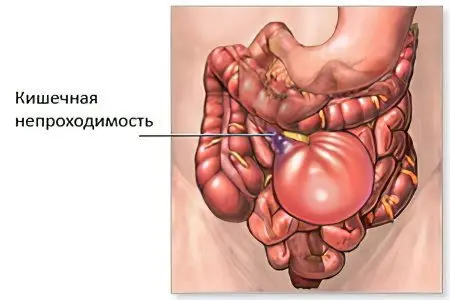 Acute intestinal obstruction: symptoms and first aid